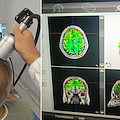 Alzheimer, al Maresca di Torre del Greco arriva la stimolazione non invasiva ad onde d'urto