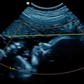 Chieti, bimba alla 24esima settimana affetta da raro caso di anemia fetale: salvata da trasfusioni in utero