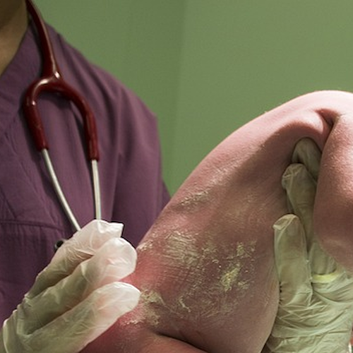 Lecce, neonata nasce in astinenza da cocaina: la scoperta all'ospedale di Galatina 